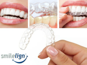 Dentist is Taunton, Smilelign clear braces
