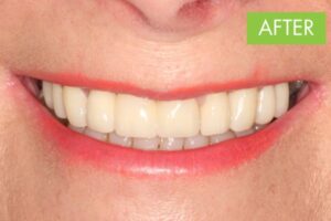 close up of teeth in after shot
