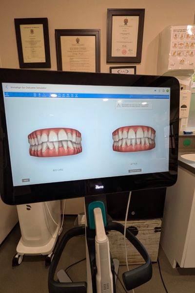 3d scan of how straightened teeth may look after invisalign