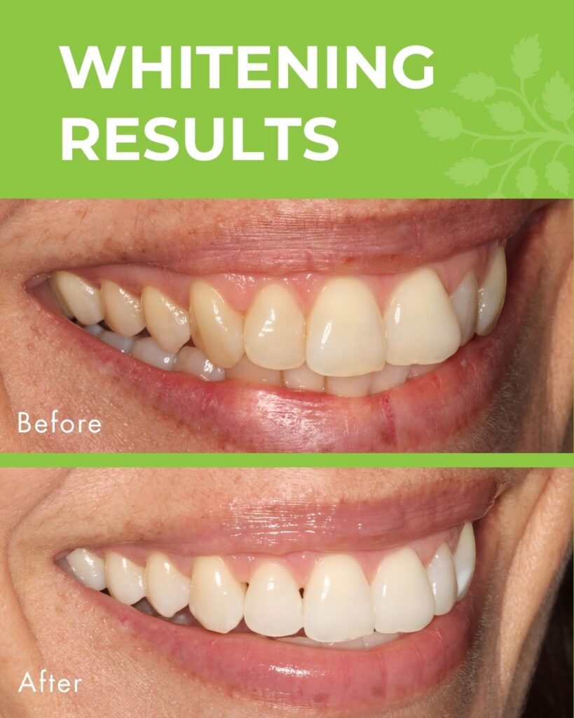 image showing results of teeth whitening with before and after shots